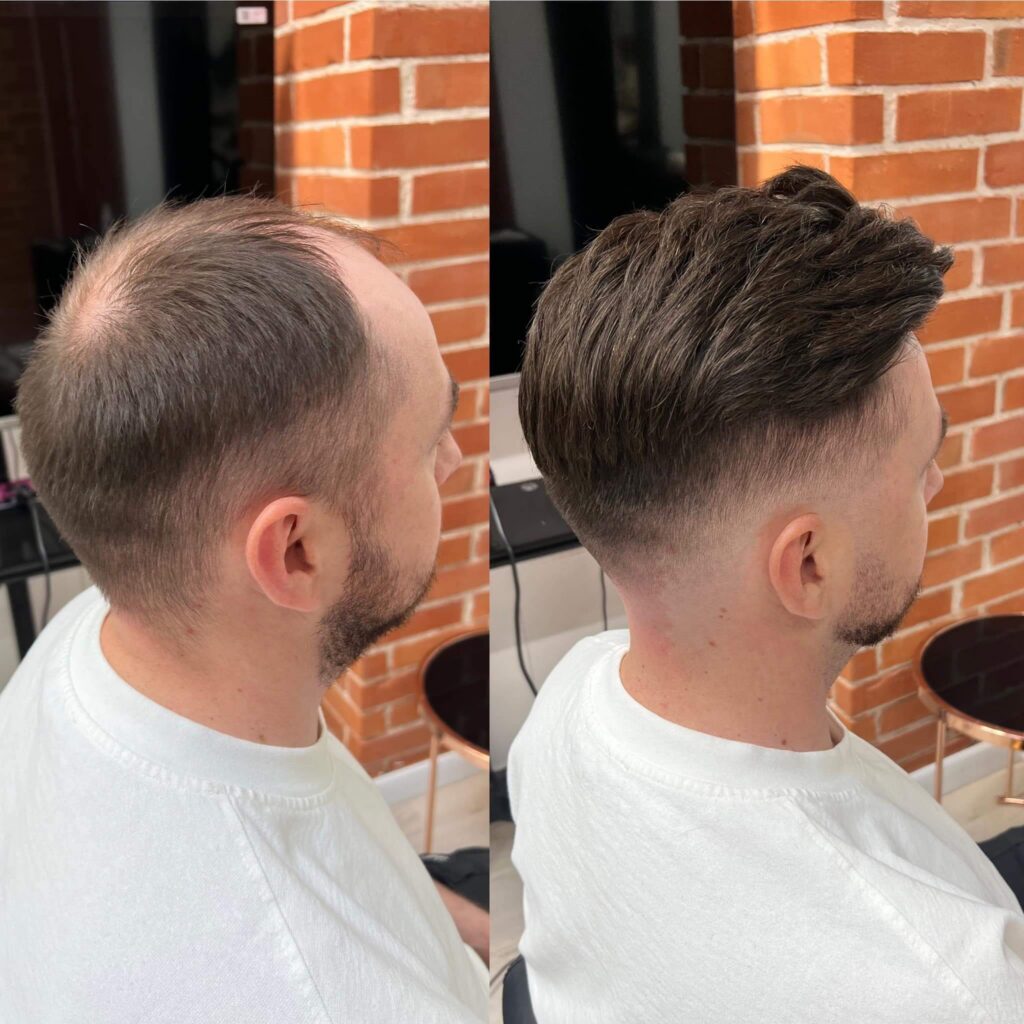 systemy męskich włosów